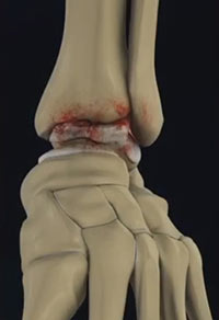 Foot and Ankle Osteoarthritis