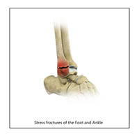 Stress Fracture of the Foot